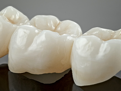 Dental Bridges